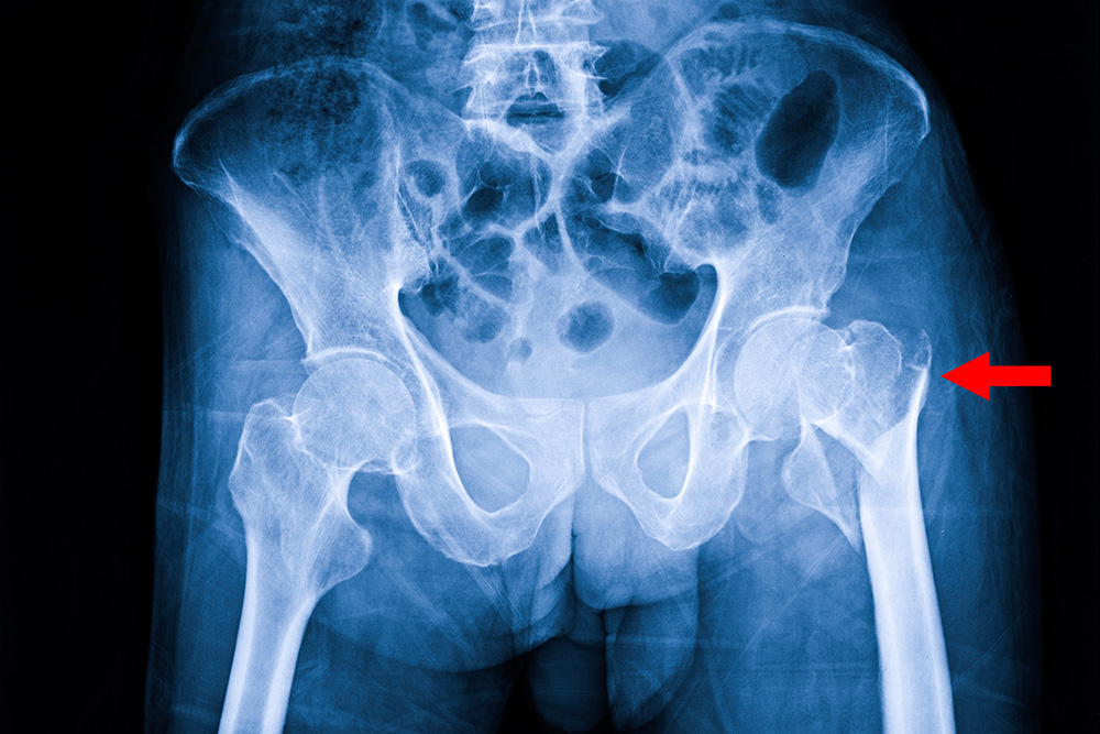 X-ray image of a human pelvis and hips with a red arrow pointing to the right hip joint, highlighting a possible abnormality or injury in that area.