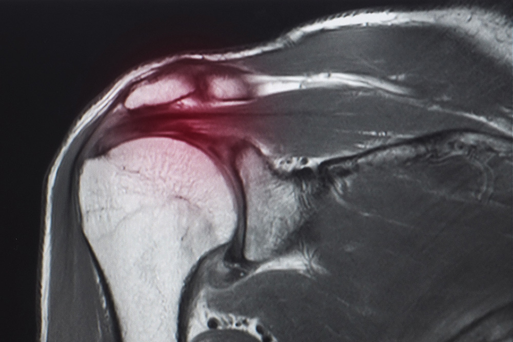 MRI scan of a shoulder joint showing a highlighted area in red, indicating possible inflammation or injury near the rotator cuff or soft tissue.