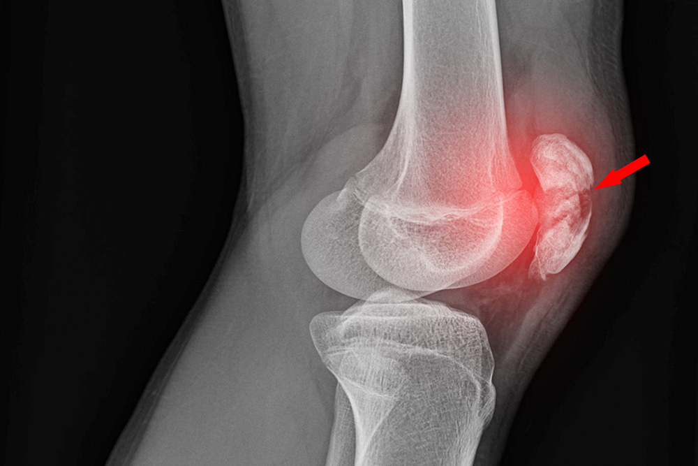X-ray of a human knee joint with a red arrow and red highlight indicating an abnormal growth or injury next to the knee cap, possibly suggesting a fracture or bone spur.