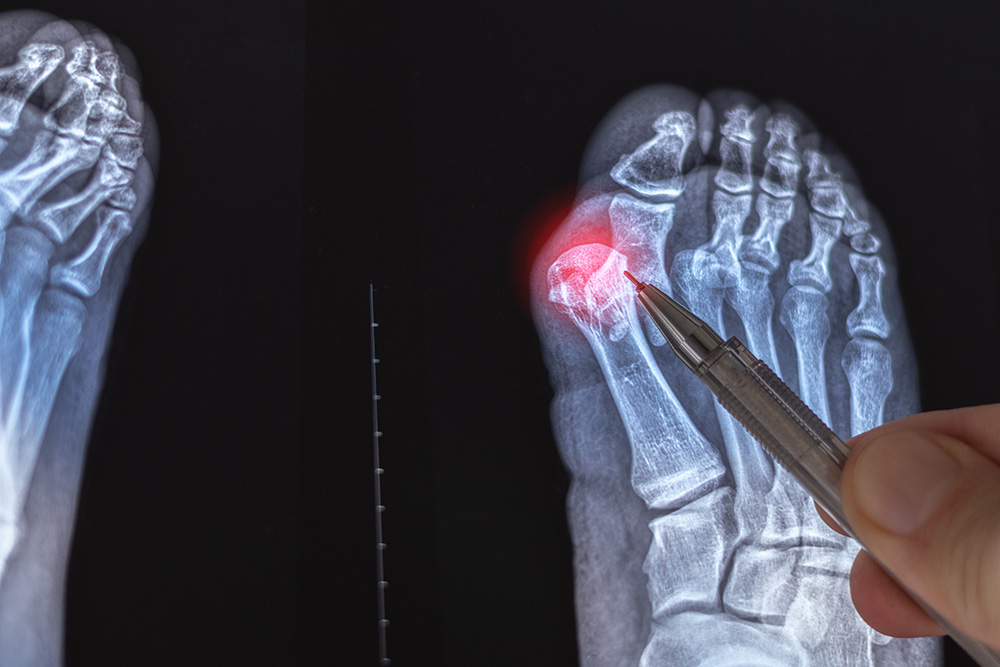 X-ray image of a human foot with a hand pointing a pen at the big toe’s joint, highlighted with a red spot, indicating a possible injury or inflammation.