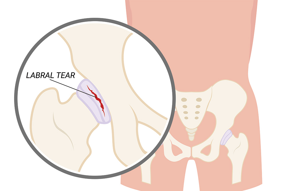 Illustration of the human pelvis showing a close-up of a hip joint with a highlighted labral tear, indicated by a jagged red line on the cartilage around the hip socket.