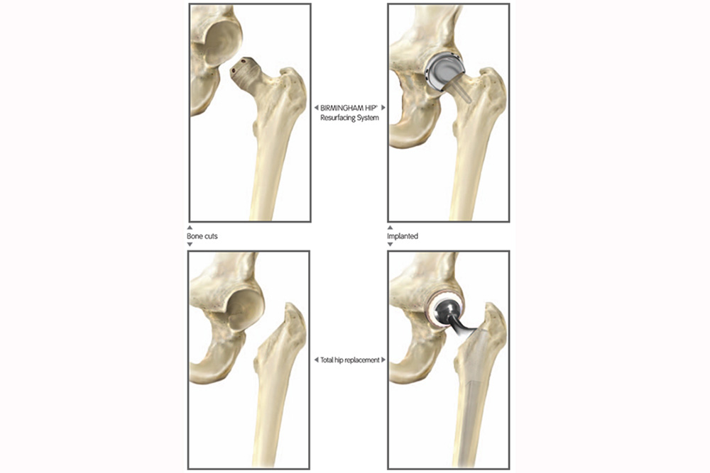 Four diagrams showing a hip joint. Top left: hip bone cut. Top right: hip with resurfacing implant. Bottom left: hip after bone cuts for total replacement. Bottom right: hip with total replacement implant in place.