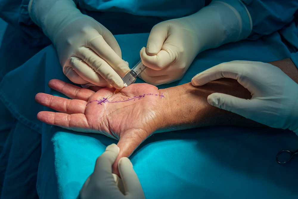 A close-up of a gloved surgeon injecting a patient’s palm, marked with purple surgical lines, likely preparing for hand surgery. Another gloved hand gently holds the patient’s hand open.